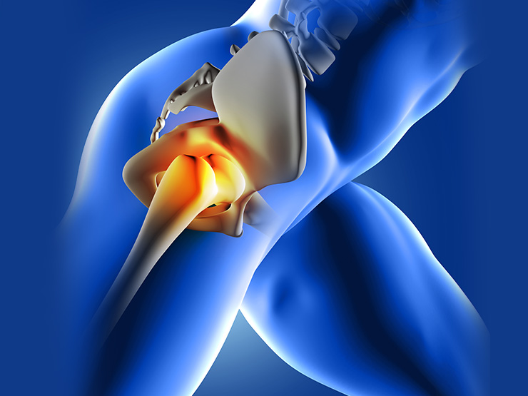 Benefits of Joint Replacement