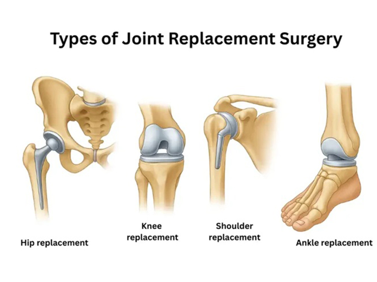 Joint Surgery